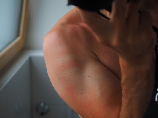 塗り薬or皮膚科？ダニに刺された時の症状と対策